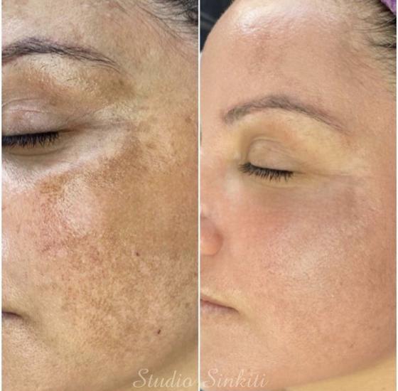 Dr.Algler Yosun Peeling 